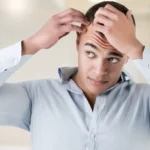 male hairloss