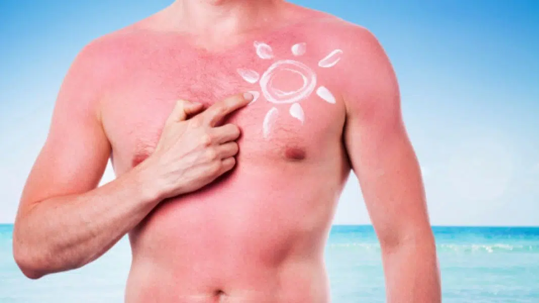 Sunburn tattoo
