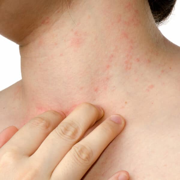 Rash