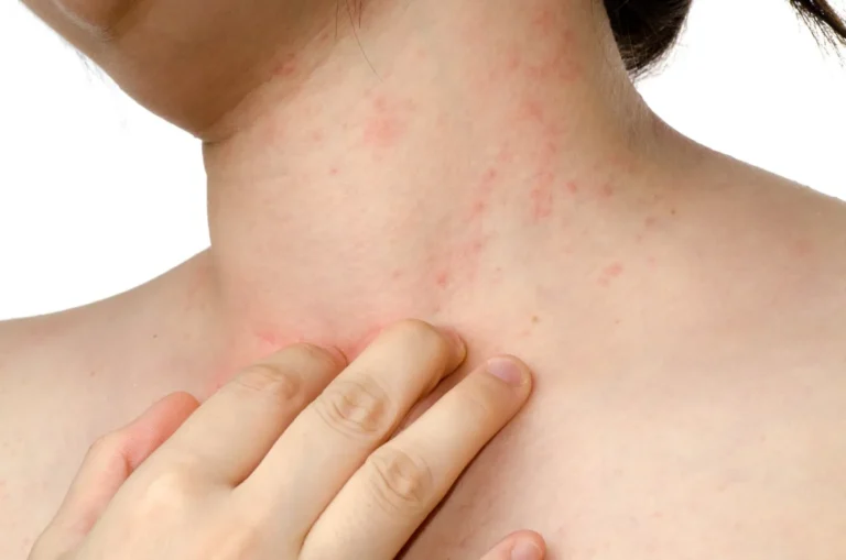 Rash