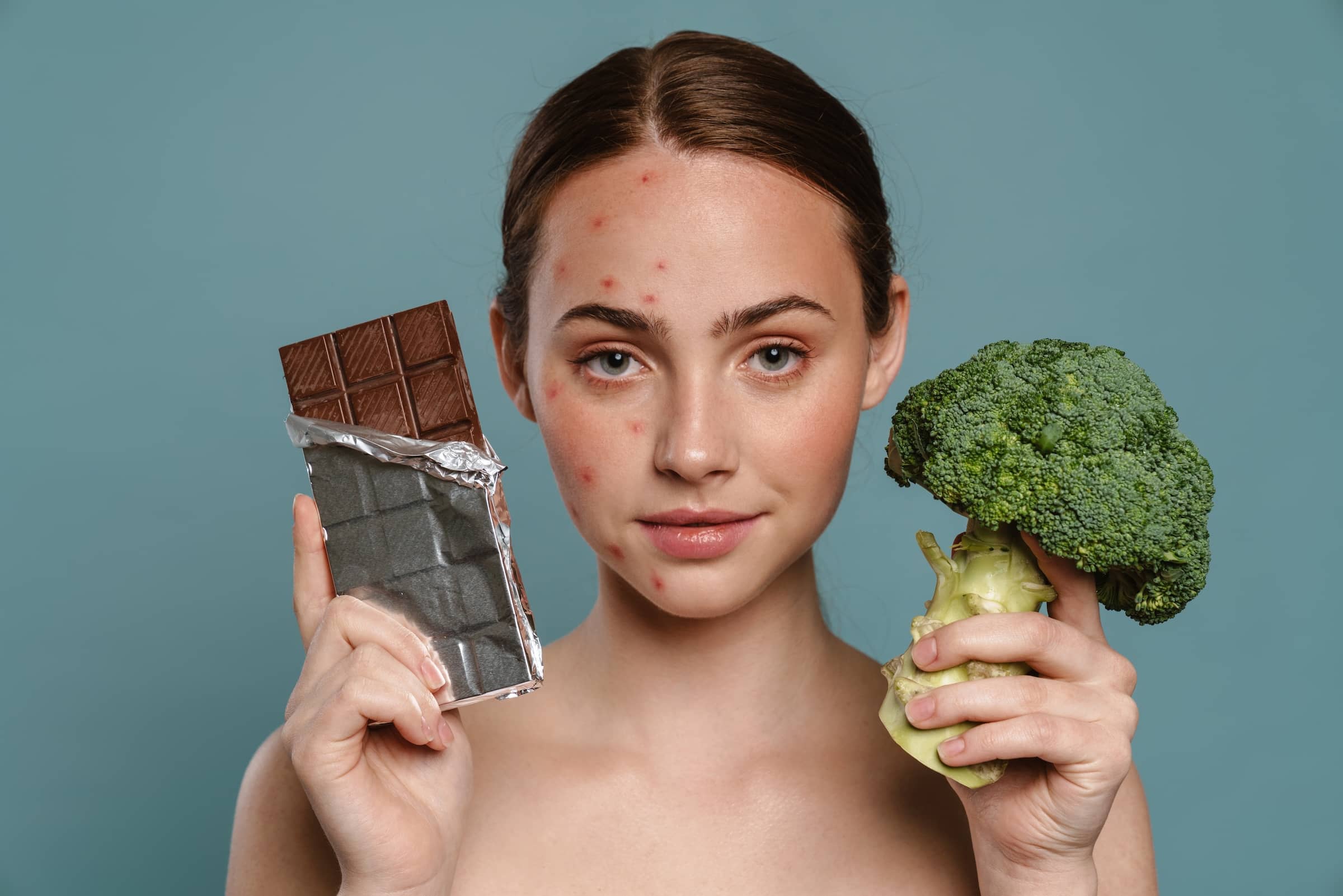 woman with spots posing with chocolate and broccoli