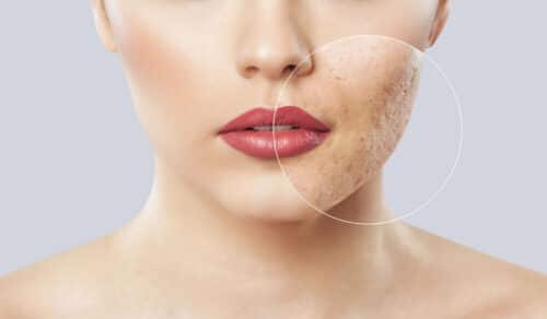 woman-with-acne-scarring
