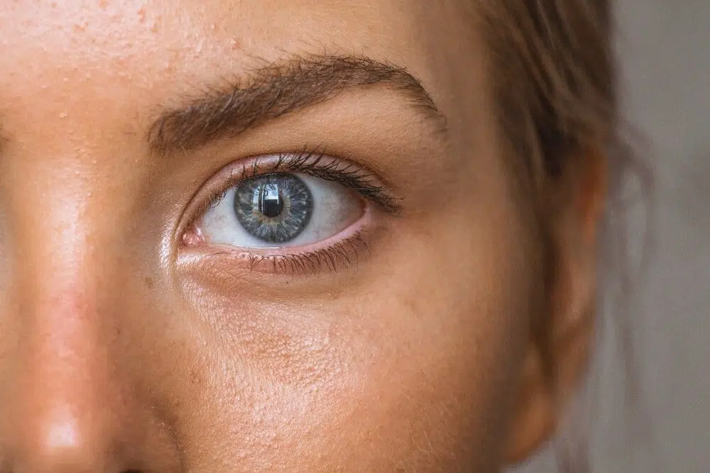Dryeyecondition