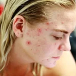 girl with inflamed acne