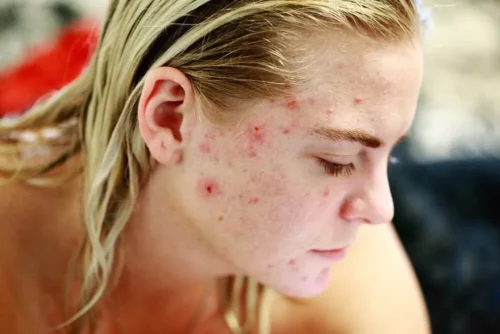 girl with inflamed acne