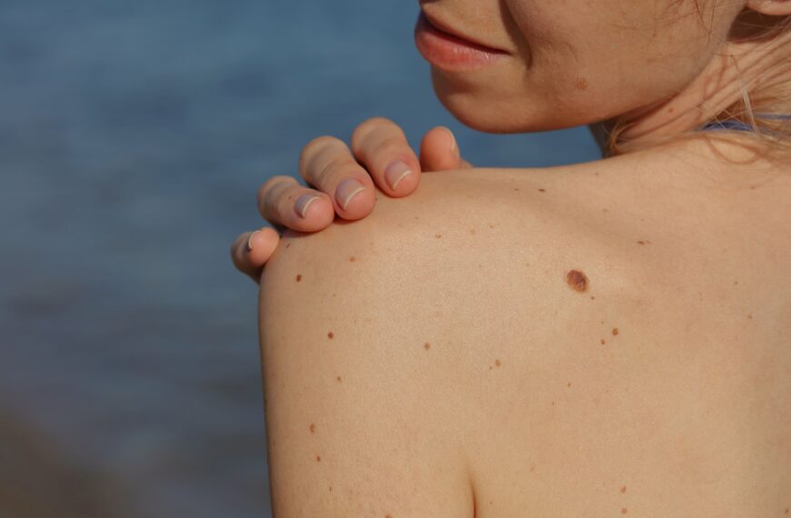 Does My Mole Need To Be Looked At By A Doctor  scaled