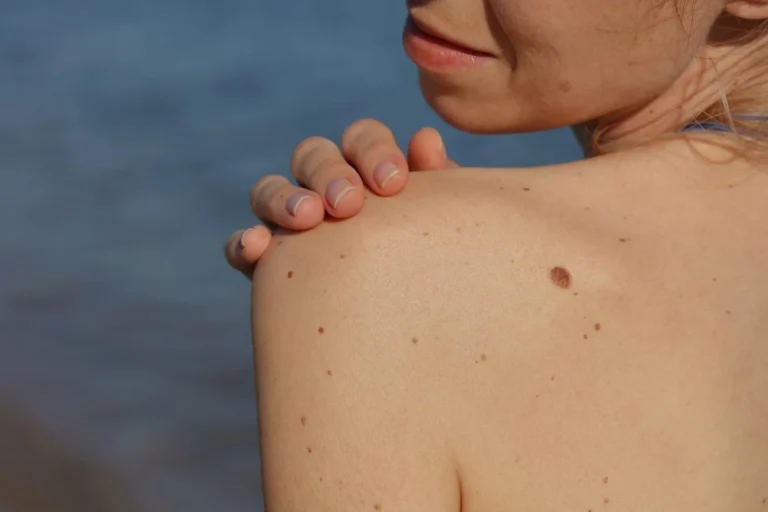 Does My Mole Need To Be Looked At By A Doctor  scaled