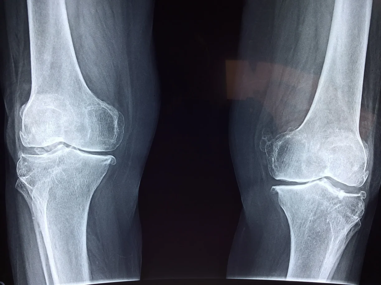 knee x ray