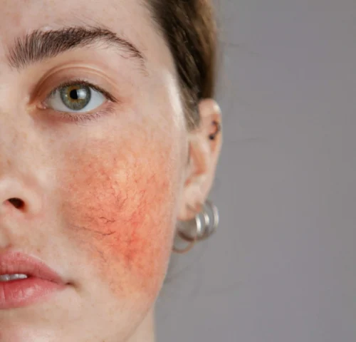 womans face covered in rosacea scaled e1621101702445