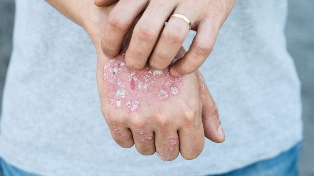 How tell if your rash is