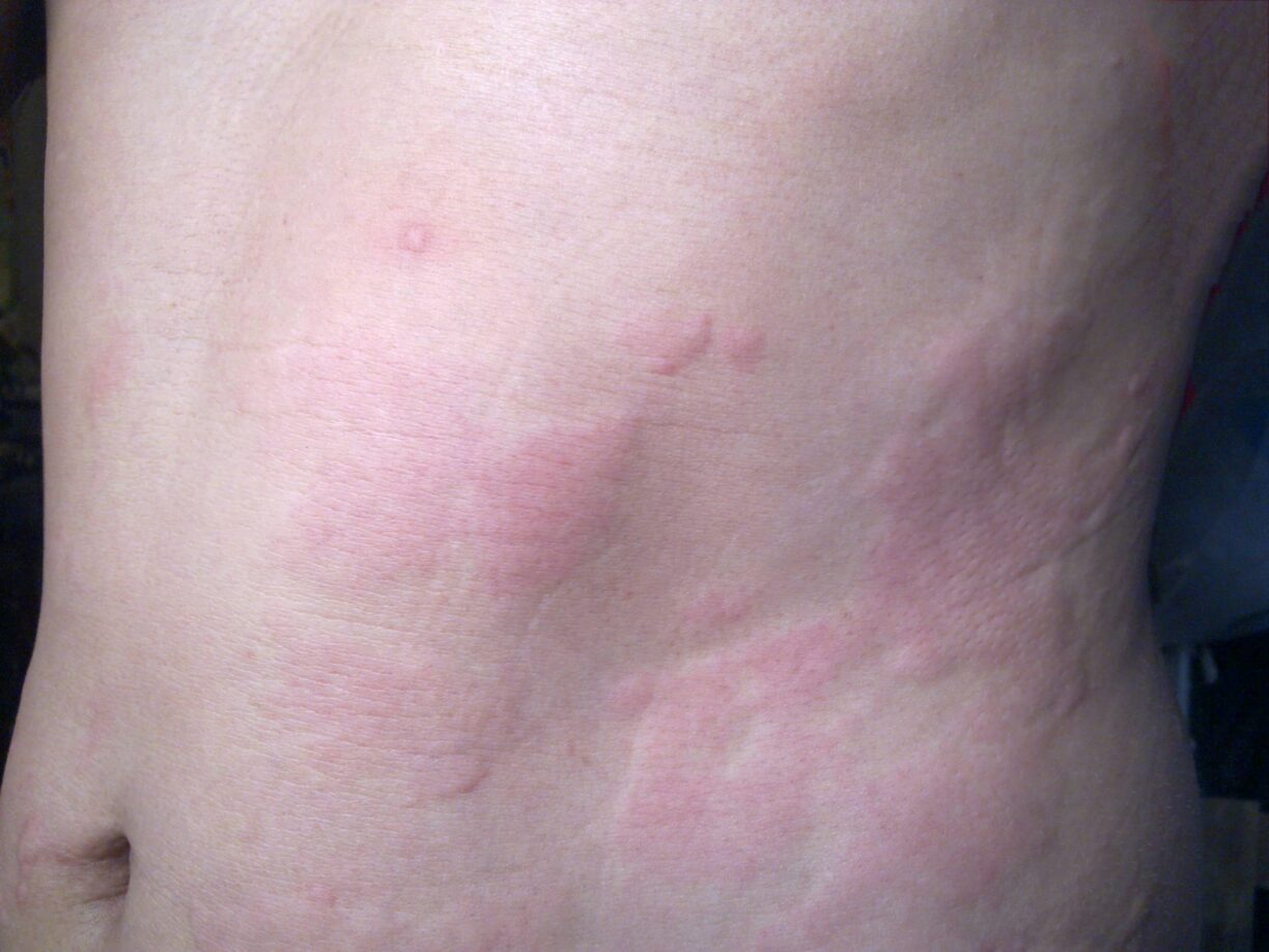 How Tell If Your Rash Is Contact Dermatitis, Eczema, Psoriasis Or Hives