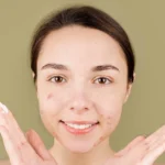 young lady with acne