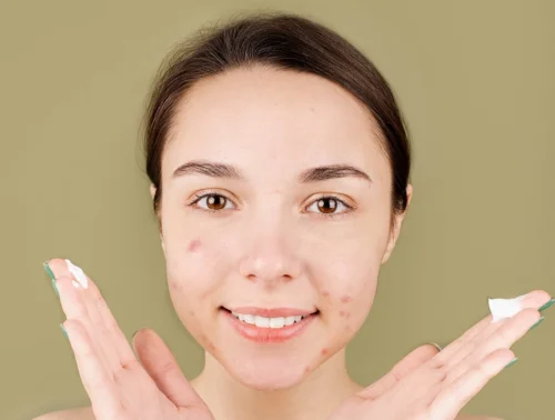 young lady with acne