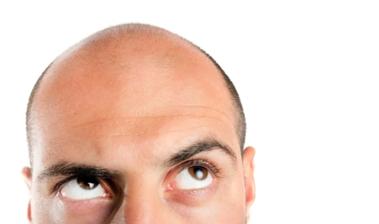 Man looks up to bald head scaled