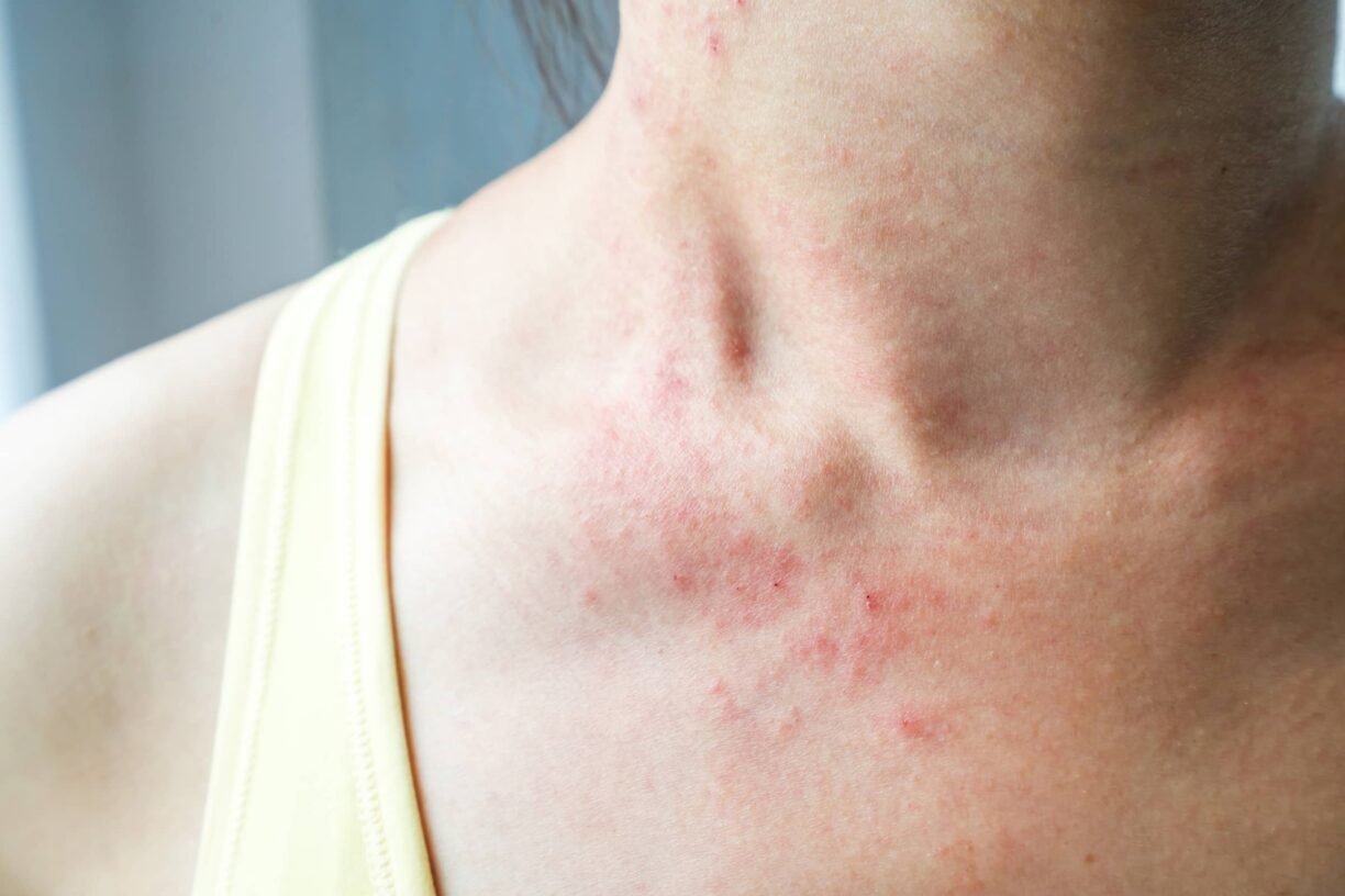 Person with rash on neck