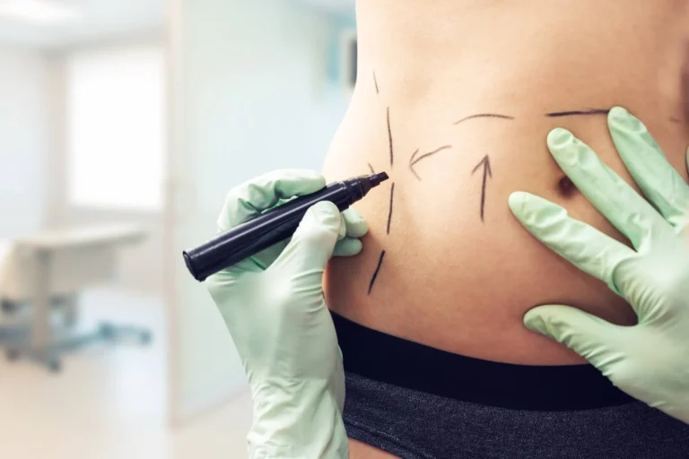 person marked up for surgery