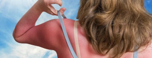woman with sunburnt back