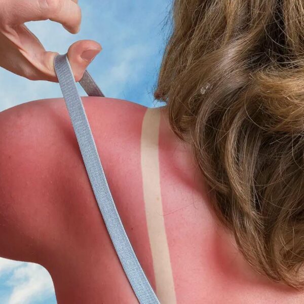 woman with sunburnt back