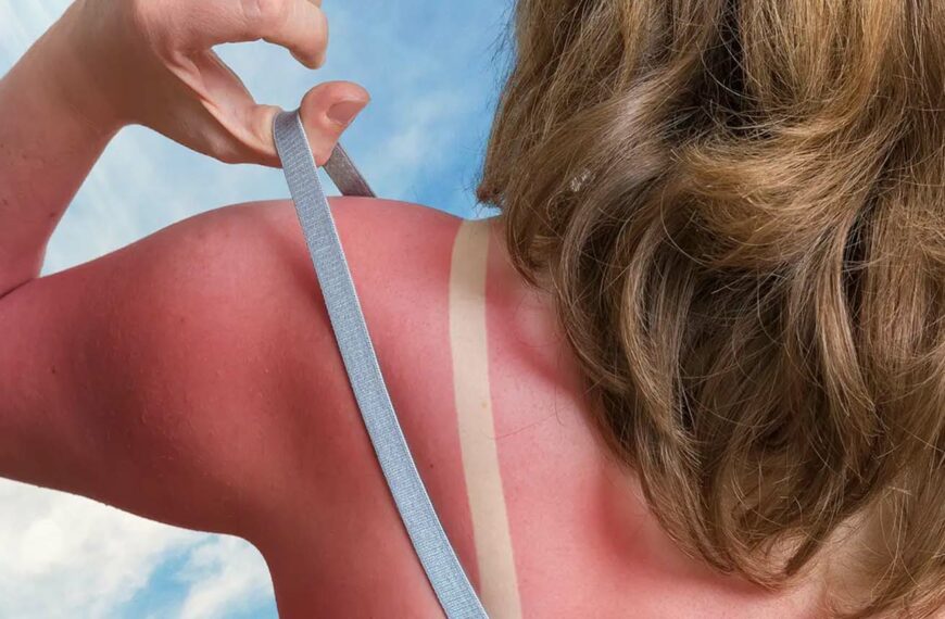 woman with sunburnt back