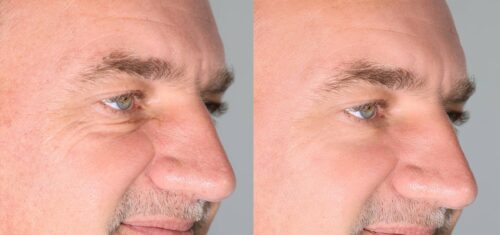 corrective procedure to remove puffy and swollen bags beneath the eye