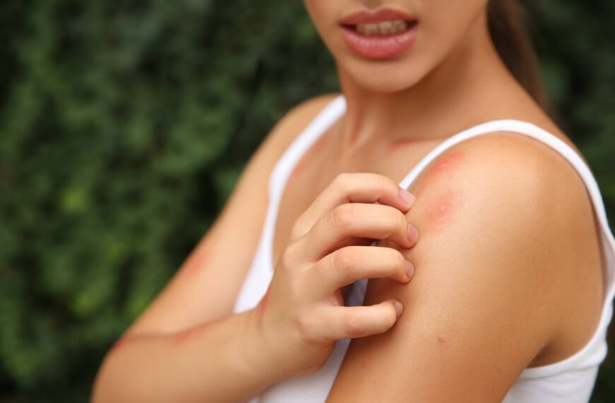 Woman scratching shoulder with insect bite outdoors, closeup