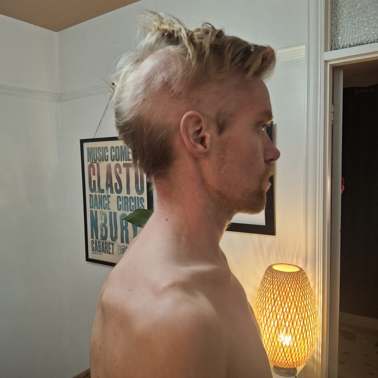 Jack Carpenter with surgery scar