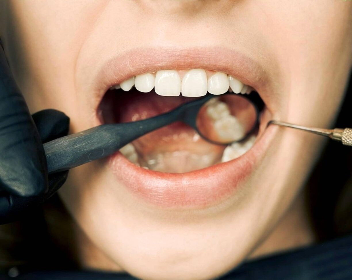 Mouth open with dentist mirror inside looking