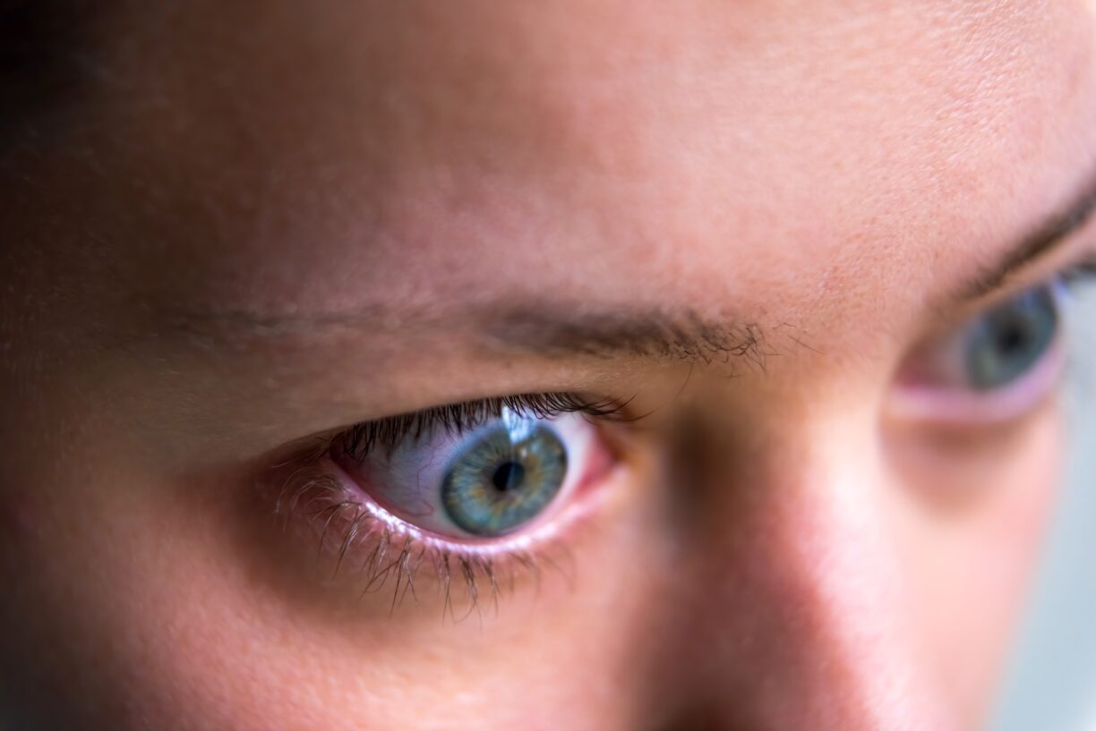 face with Grave's disease hyperthyroidism symptoms of ophthalmopathy bulging eyes and proptosis edema