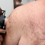 Andy Arm Mole Check