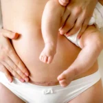 Closeup of woman belly with a scar from a cesarean section. Woman with baby on her hand