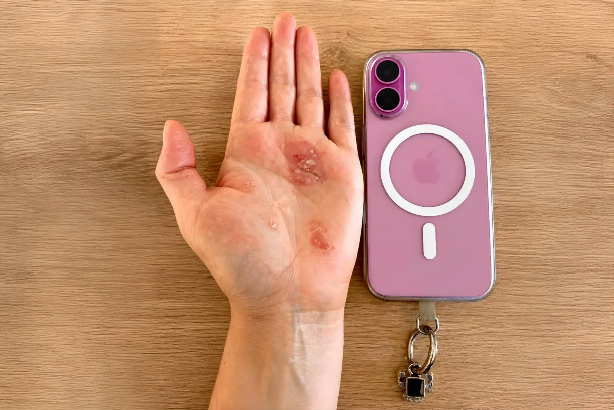 Burnt hand next to iPhone