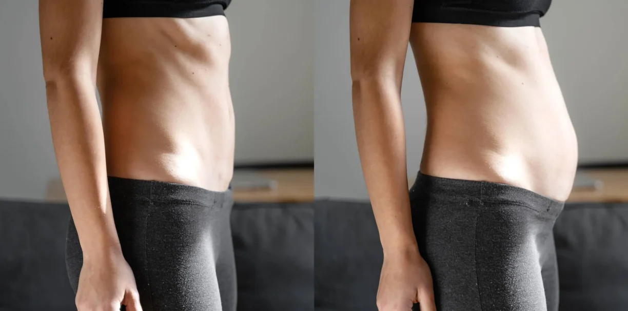Womans stomach viewed side-on for Diastis Recti